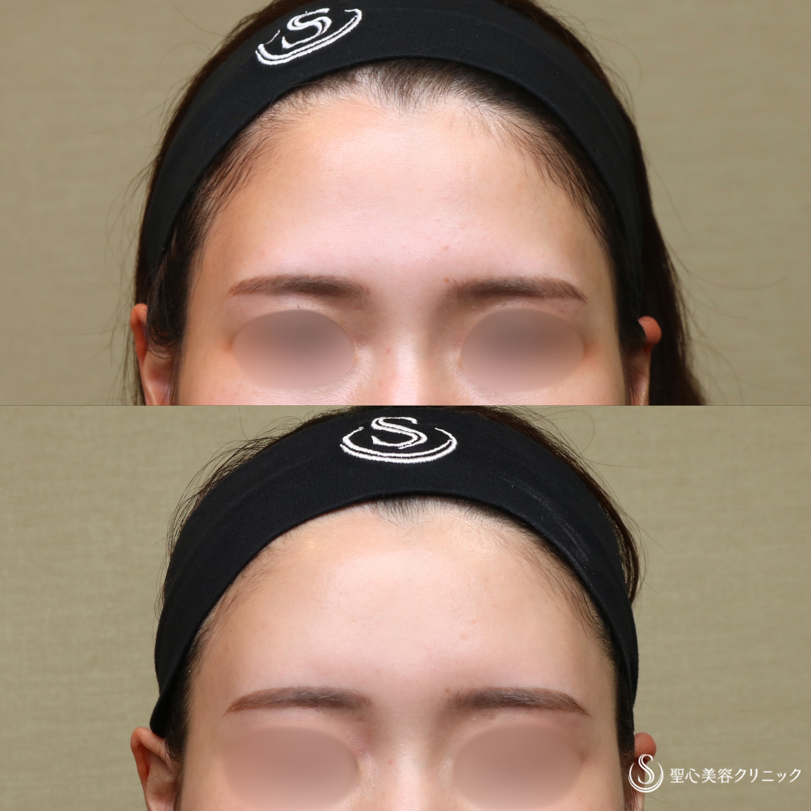 【20代女性・自然な立体感】プレミアムPRP皮膚再生療法（額）（6ヶ月後） After 名古屋院