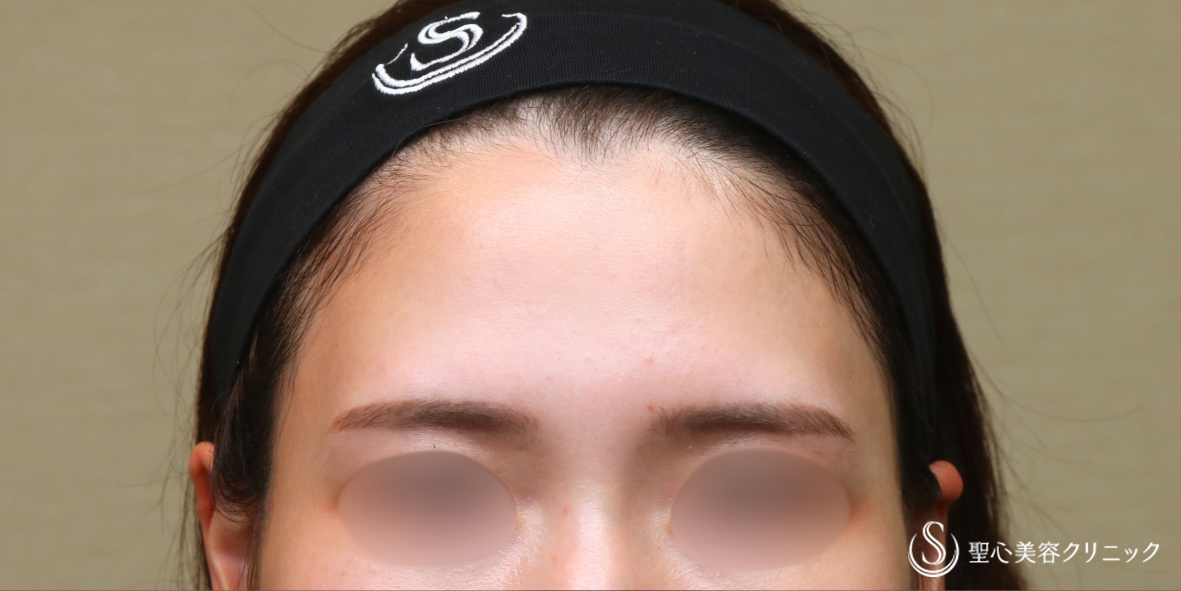 【20代女性・自然な立体感】プレミアムPRP皮膚再生療法（額）（6ヶ月後） Before 