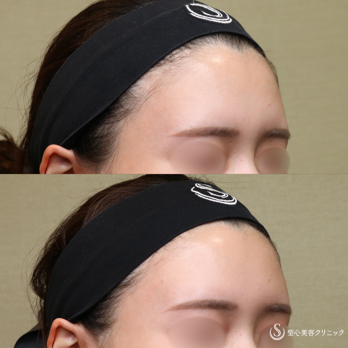 【20代女性・自然な立体感】プレミアムPRP皮膚再生療法（額）（6ヶ月後） After 名古屋院
