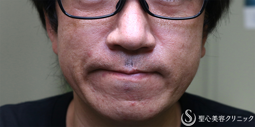 【40代男性・法令線を目立たなく】プレミアムPRP皮膚再生療法（1年後） After 