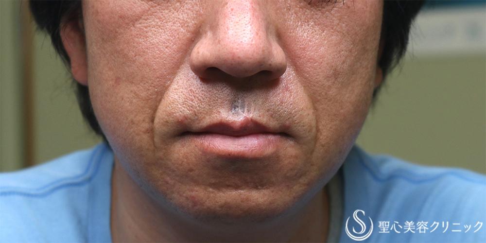 【40代男性・法令線を目立たなく】プレミアムPRP皮膚再生療法（1年後） Before 