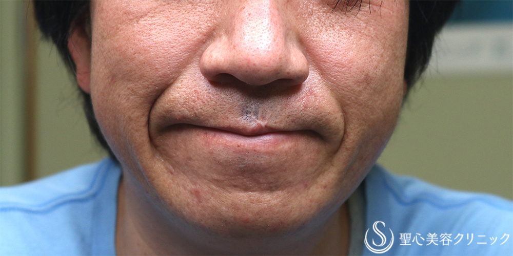 【40代男性・法令線を目立たなく】プレミアムPRP皮膚再生療法（1年後） Before 