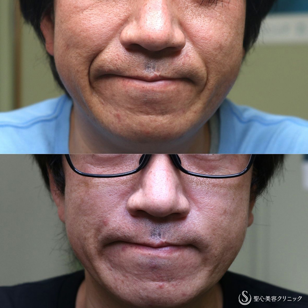 【40代男性・法令線を目立たなく】プレミアムPRP皮膚再生療法（1年後） After 名古屋　若返り　ヒアルロン酸注入　シワケア