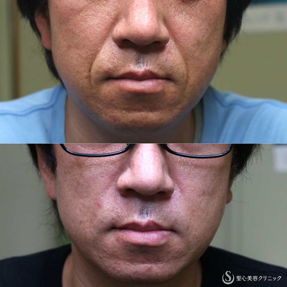 【40代男性・法令線を目立たなく】プレミアムPRP皮膚再生療法（1年後） After 名古屋　若返り　ヒアルロン酸注入　シワケア