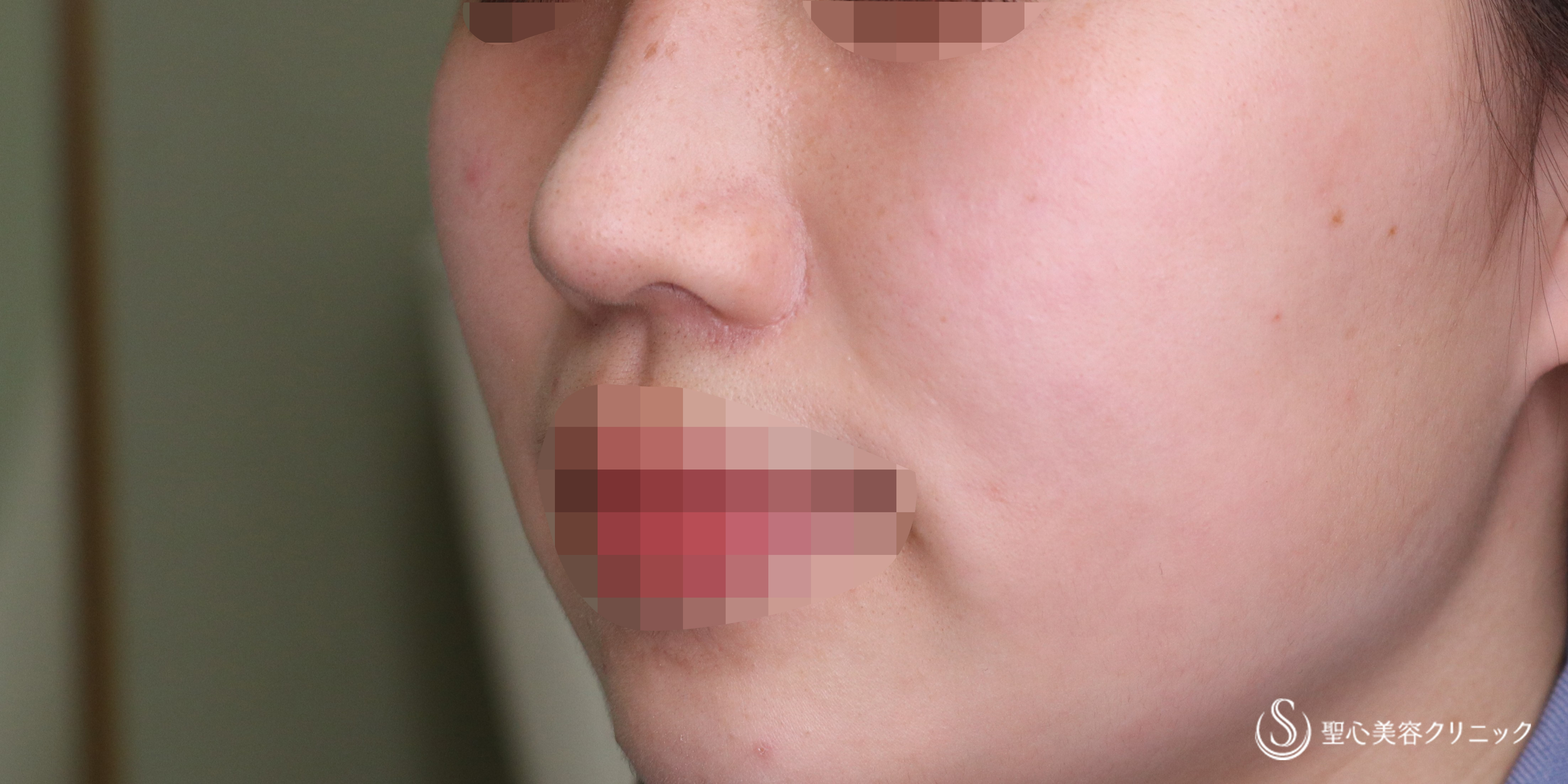 【20代女性・自然な忘れ鼻へ】小鼻縮小（2年後） After 