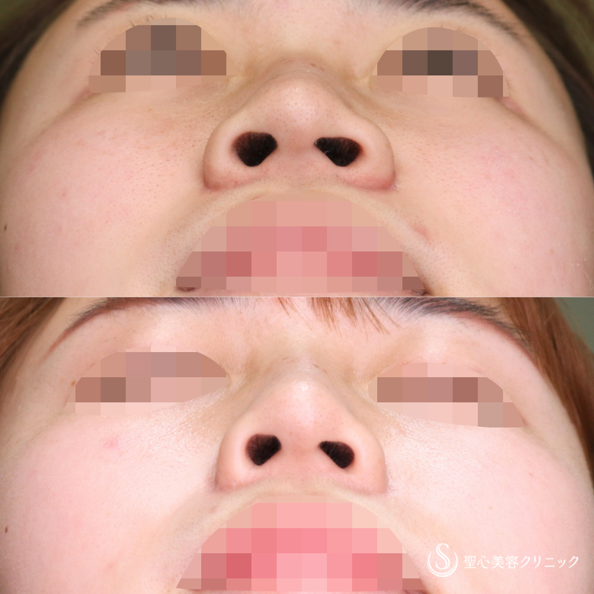【20代女性・自然な忘れ鼻へ】小鼻縮小（2年後） After 名古屋院