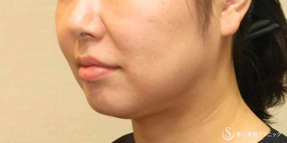 【40代女性・顎下もすっきり】脂肪吸引注射（頬＋顎）（1ヶ月後） Before 