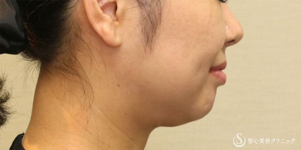 【40代女性・顎下もすっきり】脂肪吸引注射（頬＋顎）（1ヶ月後） Before 