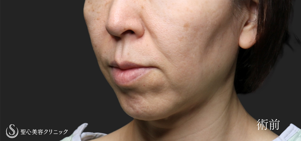 【40代女性・フェイスリフトで圧倒的な引き上げを】フェイスリフト（1ヶ月後） Before 
