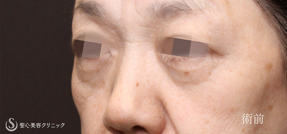 【50代女性・ハムラ法で目の下のたるみをスッキリと】ハムラ法（1ヶ月後） Before 