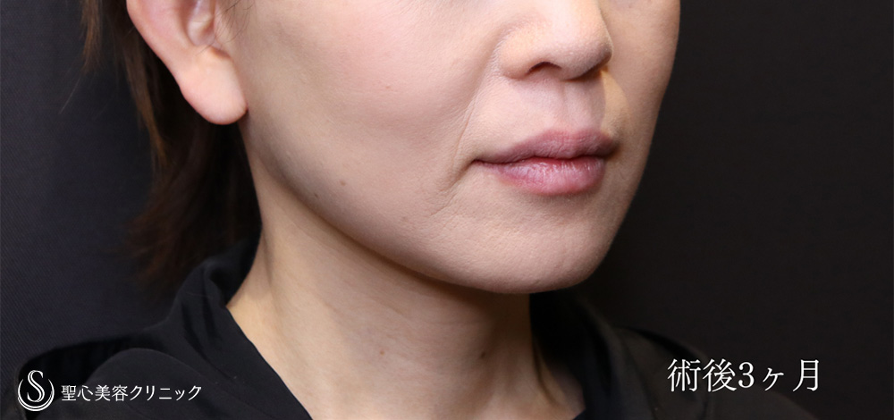 【50代女性・フェイスラインをシャープに】フェイスリフト＋脂肪吸引（頬＋顎）＋リガメント処置（3ヶ月後） After 