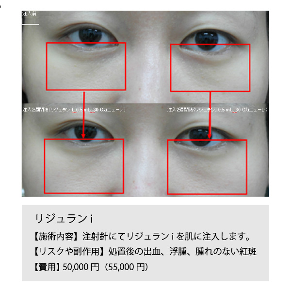 リジュランiの症例