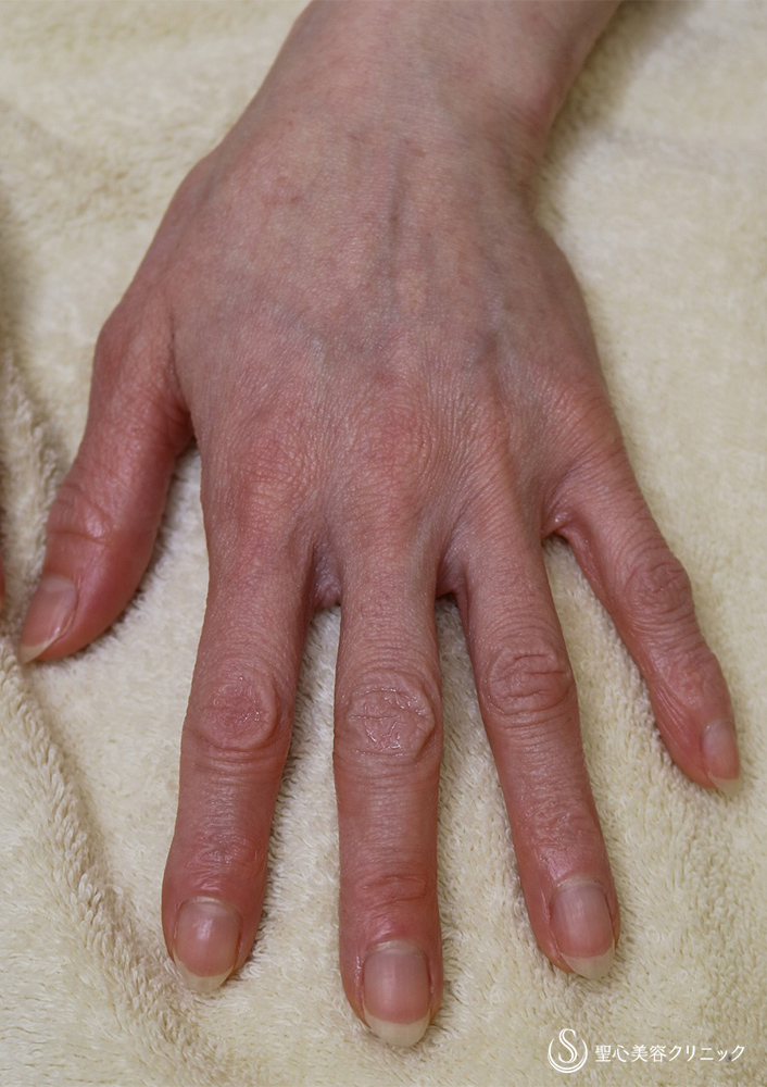 【50代女性・手の甲】プレミアムPRP皮膚再生療法（10ヶ月後） After 