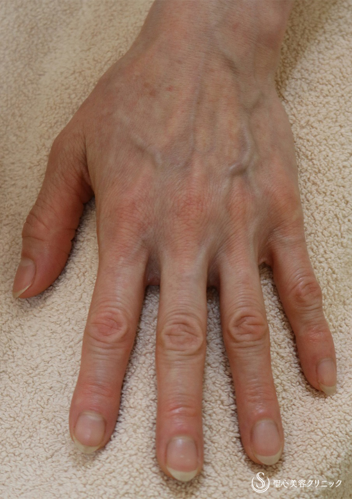 【50代女性・手の甲】プレミアムPRP皮膚再生療法（10ヶ月後） Before 