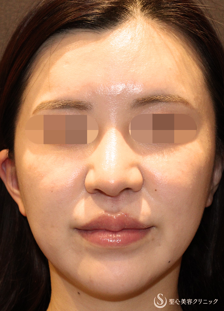 【30代女性・口角が上がり綺麗なM字リップに】ヒアルロン酸注入（口唇）（直後） After 