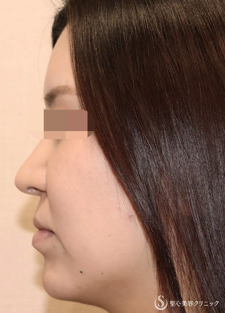 【30代女性・口角が上がり綺麗なM字リップに】ヒアルロン酸注入（口唇）（直後） Before 