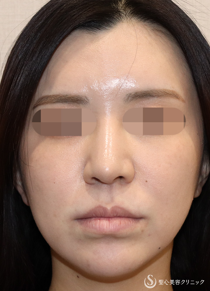 【30代女性・口角が上がり綺麗なM字リップに】ヒアルロン酸注入（口唇）（直後） Before 