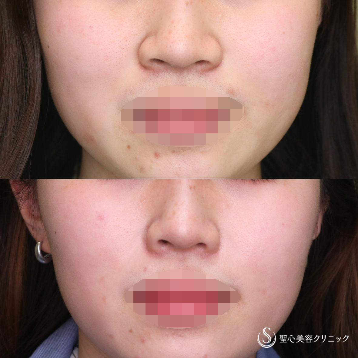 【20代女性・自然な忘れ鼻へ】小鼻縮小（2年後） After 名古屋院