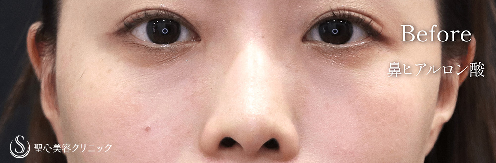 【20代女性・ヒアルロン酸で鼻筋が通る】ヒアルロン酸注入（鼻）（1週間後） Before 