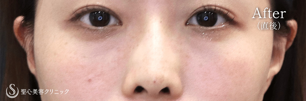 【20代女性・ヒアルロン酸で鼻筋が通る】ヒアルロン酸注入（鼻）（1週間後） After 