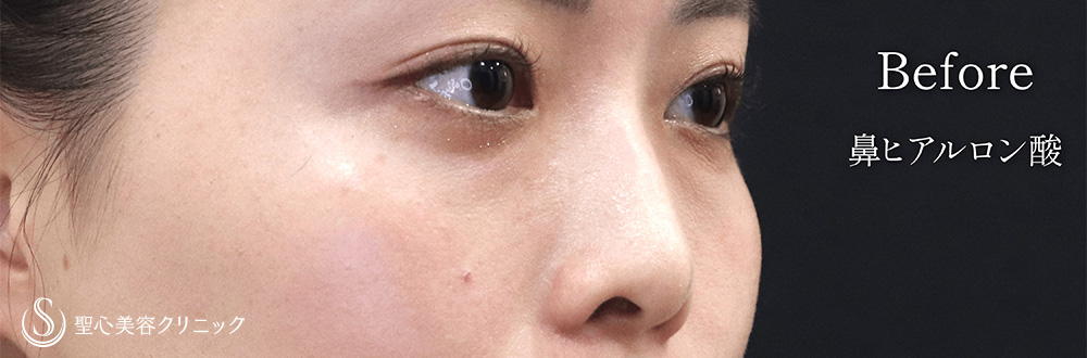 【20代女性・ヒアルロン酸で鼻筋が通る】ヒアルロン酸注入（鼻）（1週間後） Before 
