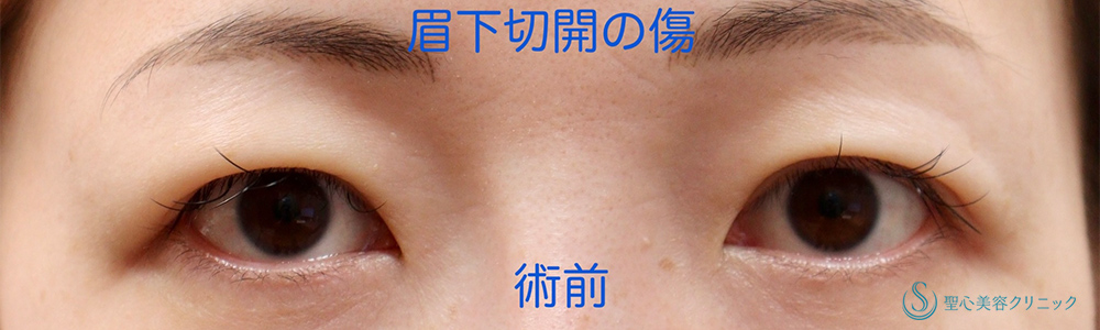 【30代女性・目の上のたるみ処置】眉下切開法（眉下リフト）（6ヶ月後） Before 