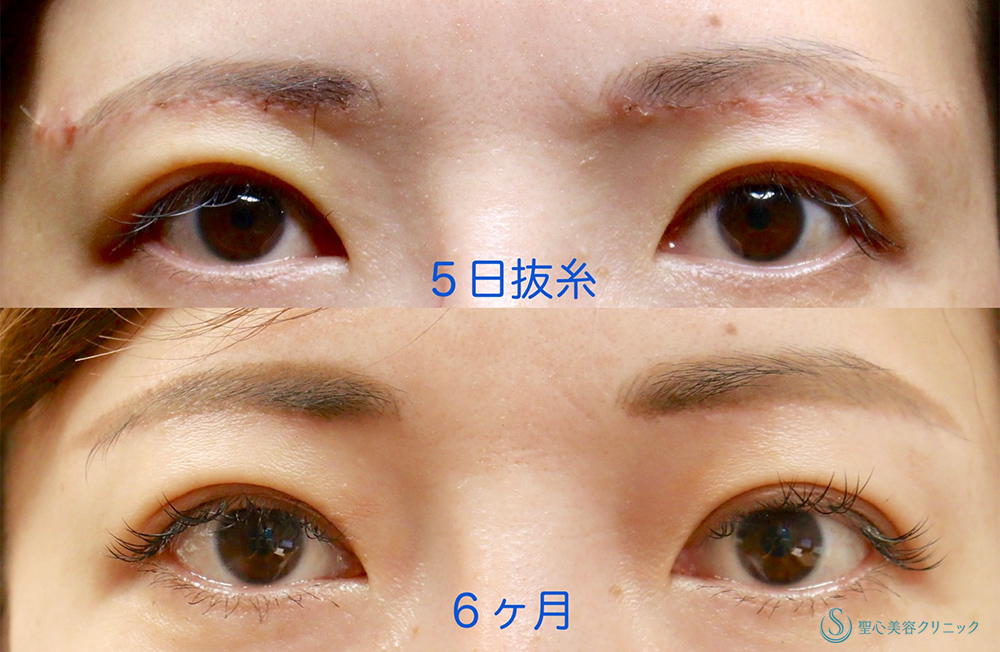 【30代女性・目の上のたるみ処置】眉下切開法（眉下リフト）（6ヶ月後） After 