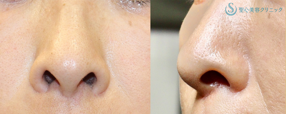 【40代女性・鼻の穴が見えるのが気になる】鼻孔縁下降術＋小鼻縮小（1週間後） Before 