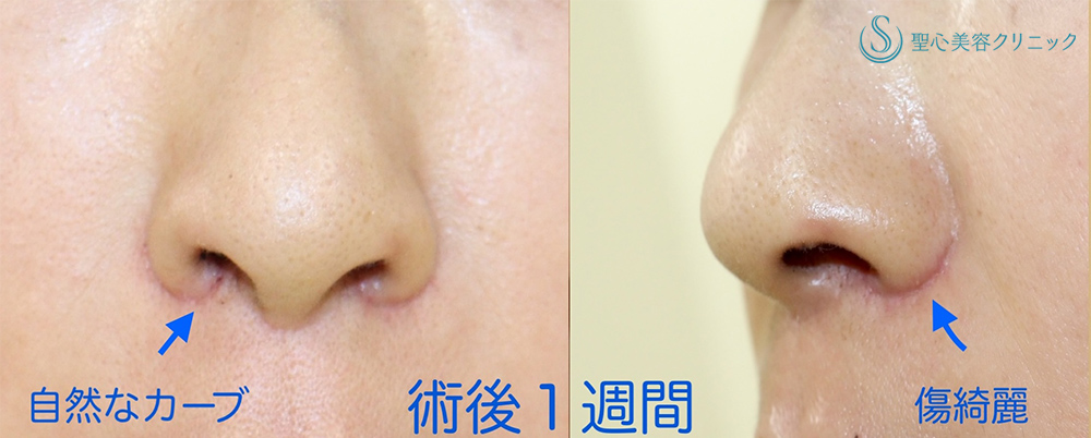 【40代女性・鼻の穴が見えるのが気になる】鼻孔縁下降術＋小鼻縮小（1週間後） After 