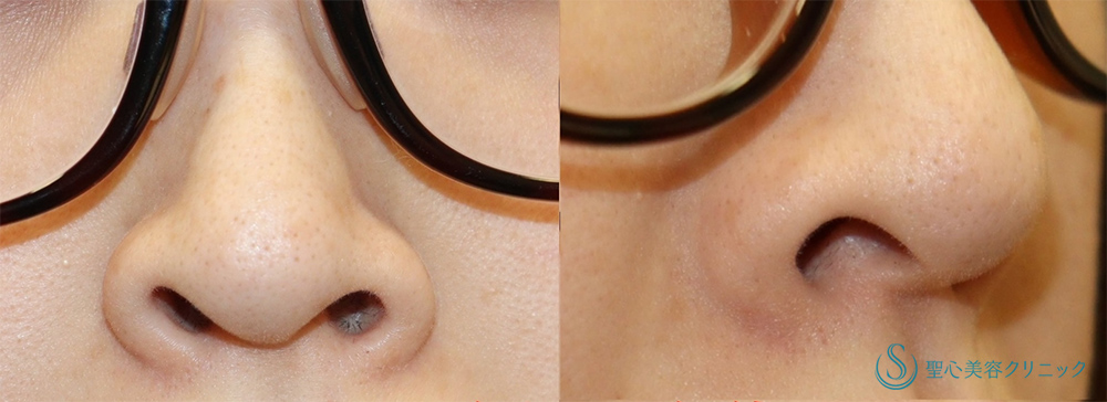 【30代女性・鼻の穴が見えるのが気になる】鼻孔縁下降術（1週間後） Before 