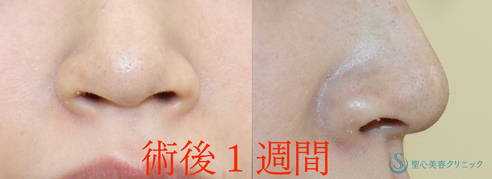 【30代女性・鼻の穴が見えるのが気になる】鼻孔縁下降術（1週間後） After 