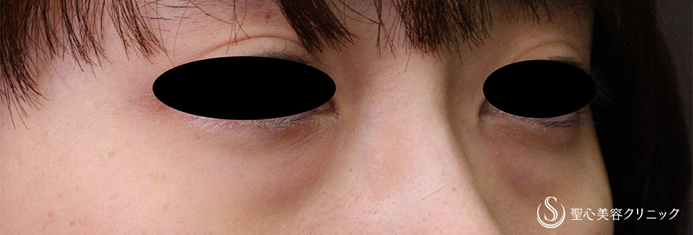 【20代女性・目の下のくま】経結膜下脱脂法（1ヶ月後） Before 