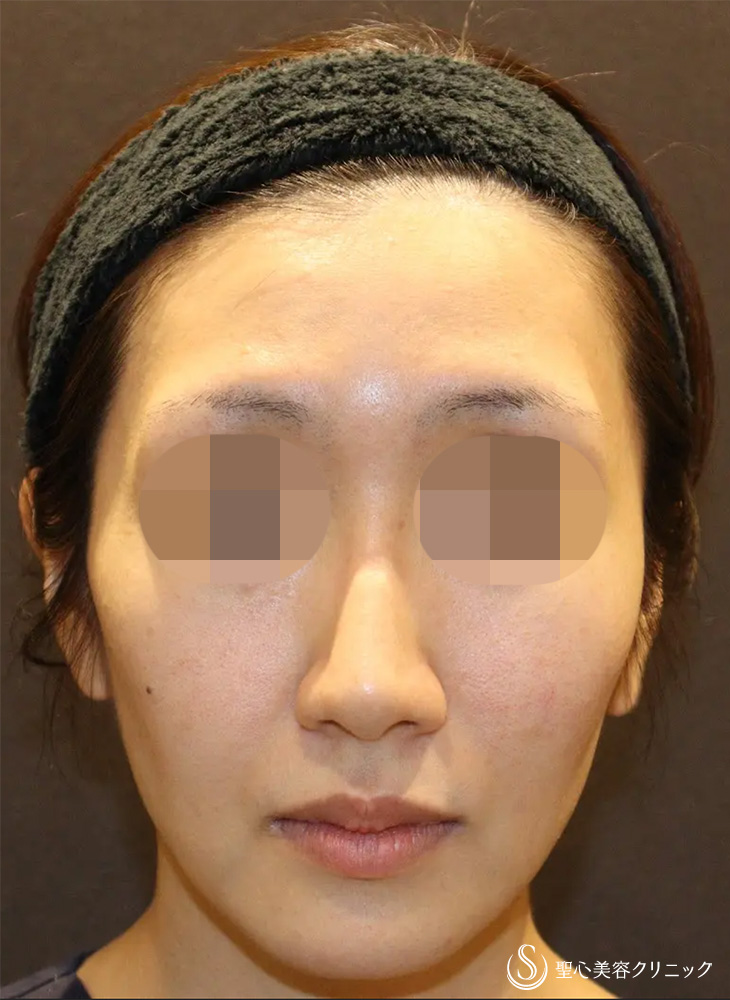 【30代女性・凹凸がなくなり小顔に見えます】ヒアルロン酸注入（こめかみ）（直後） Before 
