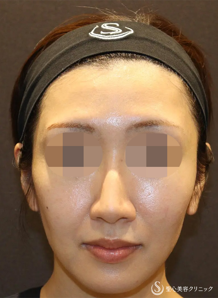 【30代女性・凹凸がなくなり小顔に見えます】ヒアルロン酸注入（こめかみ）（直後） After 