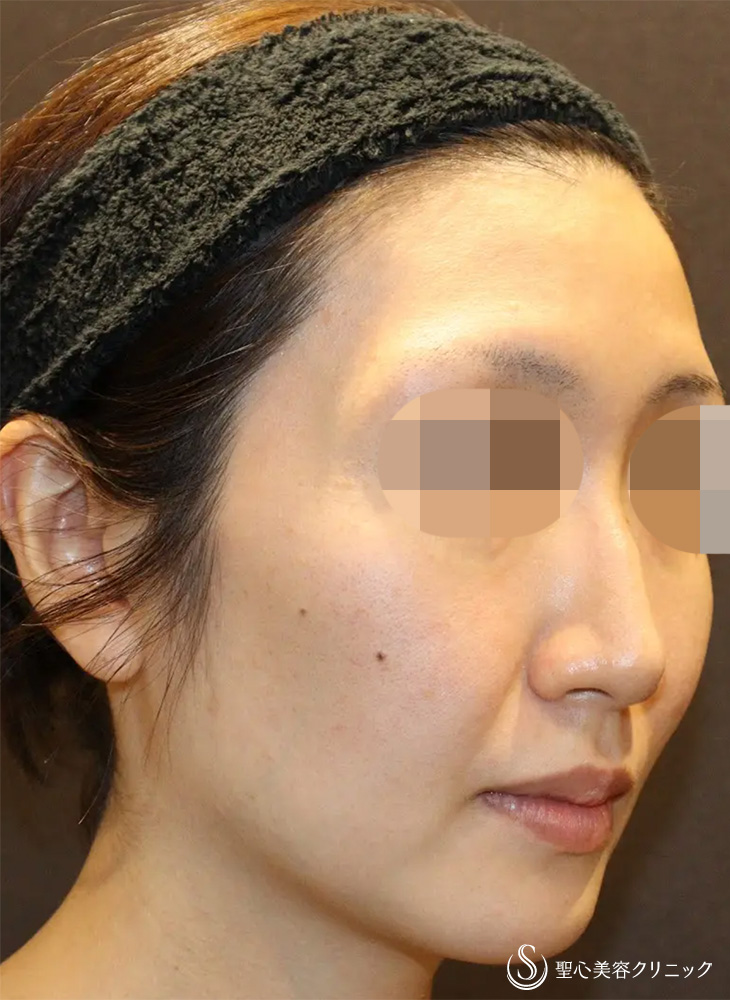 【30代女性・凹凸がなくなり小顔に見えます】ヒアルロン酸注入（こめかみ）（直後） Before 