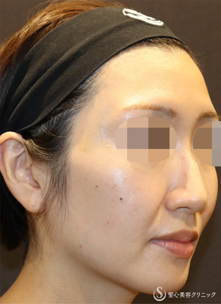 【30代女性・凹凸がなくなり小顔に見えます】ヒアルロン酸注入（こめかみ）（直後） After 