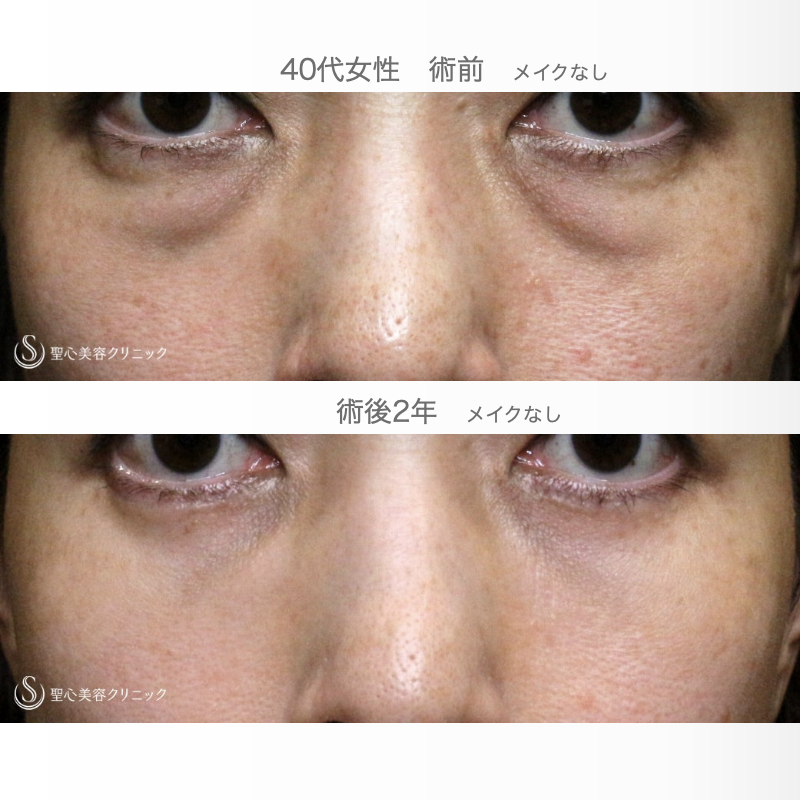 【40代女性・私が裏ハムラをしない理由】表ハムラ+α法「Ver.2.5」単独（2年後） After 