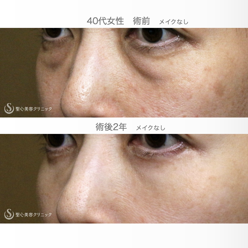 【40代女性・私が裏ハムラをしない理由】表ハムラ+α法「Ver.2.5」単独（2年後） After 