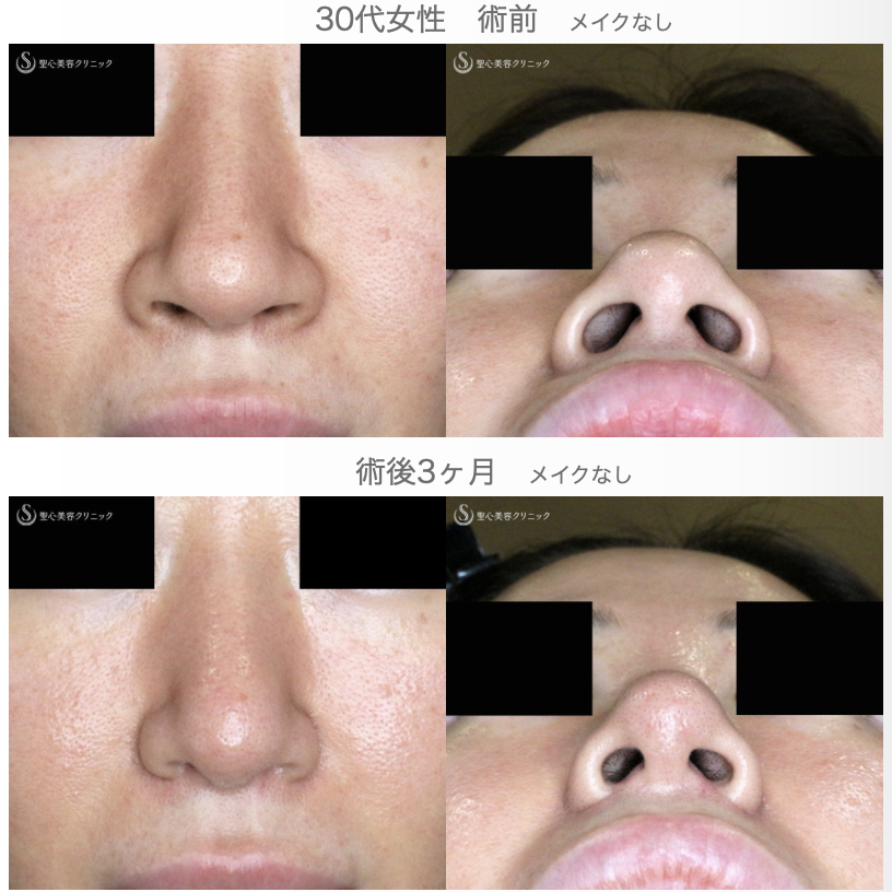 【30代女性・外を切らない最新+αで「忘れ鼻」】小鼻縮小術+α法 Ver.7.5 ＋ 鼻尖縮小術+α法 Ver.4（術直後〜3ヶ月後） Before 