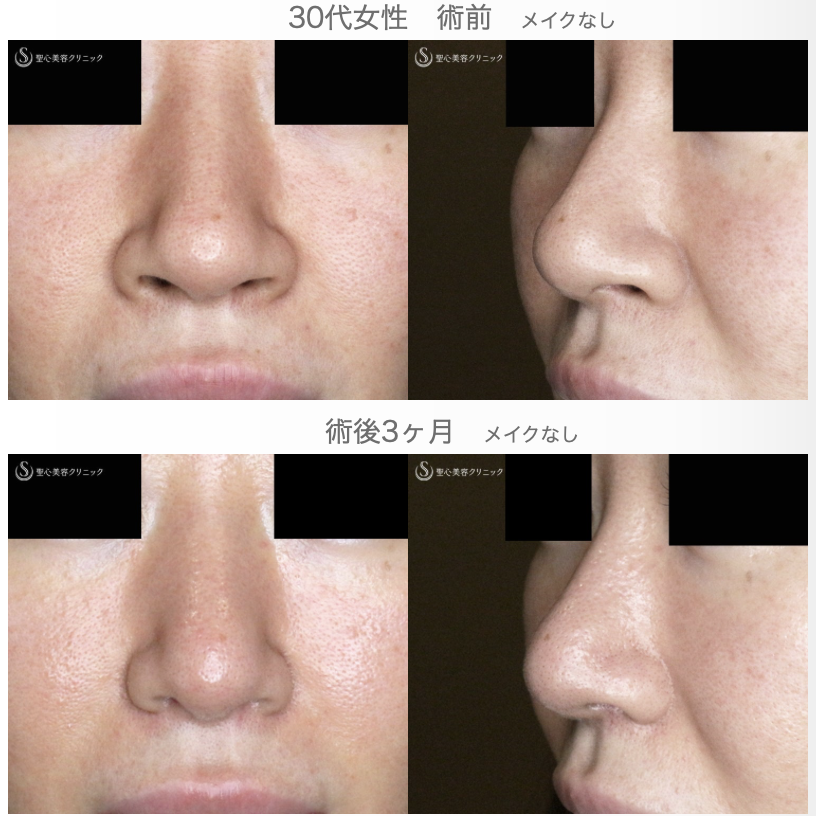 【30代女性・外を切らない最新+αで「忘れ鼻」】小鼻縮小術+α法 Ver.7.5 ＋ 鼻尖縮小術+α法 Ver.4（術直後〜3ヶ月後） After 