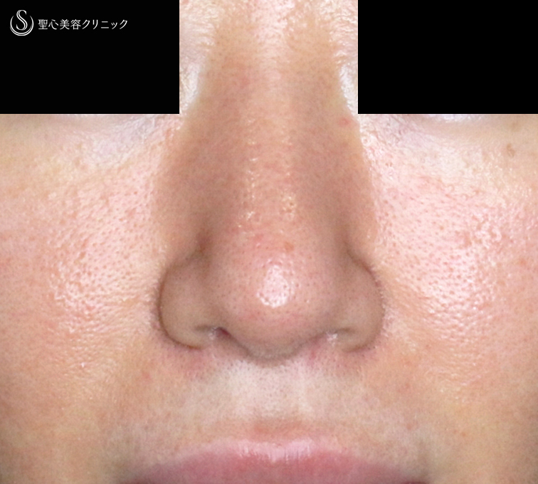 【30代女性・外を切らない最新+αで「忘れ鼻」】小鼻縮小術+α法 Ver.7.5 ＋ 鼻尖縮小術+α法 Ver.4（術直後〜3ヶ月後） After 