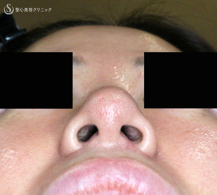 【30代女性・外を切らない最新+αで「忘れ鼻」】小鼻縮小術+α法 Ver.7.5 ＋ 鼻尖縮小術+α法 Ver.4（術直後〜3ヶ月後） After 