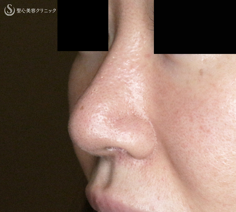 【30代女性・外を切らない最新+αで「忘れ鼻」】小鼻縮小術+α法 Ver.7.5 ＋ 鼻尖縮小術+α法 Ver.4（術直後〜3ヶ月後） After 