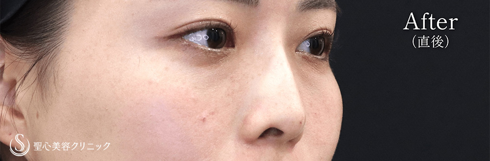 【20代女性・ヒアルロン酸で鼻筋が通る】ヒアルロン酸注入（鼻）（1週間後） After 
