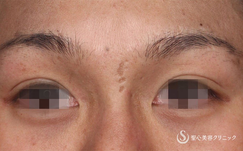 【20代男性・水疱瘡跡】傷跡修正（術後1ヶ月） Before 