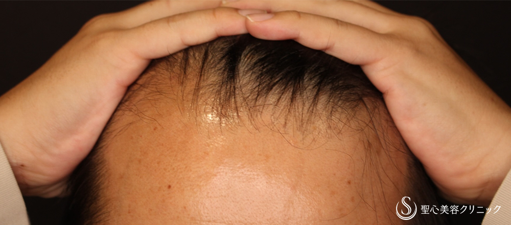 【30代男性・薄毛AGA】EXOHAIR EVs（5回治療・2ヶ月後） Before 