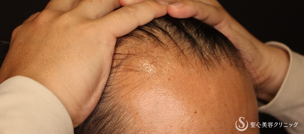 【30代男性・薄毛AGA】EXOHAIR EVs（5回治療・2ヶ月後） Before 