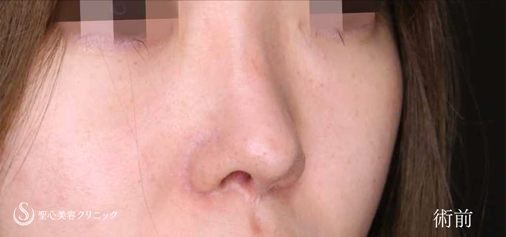 【20代女性・鼻の尖りを自然に改善】鼻孔縁下降術（3ヶ月後） Before 