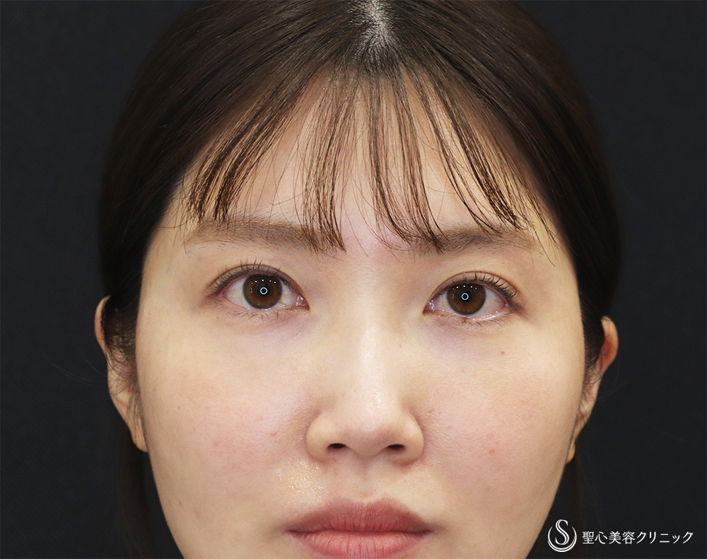 【30代女性・優しく豊かな表情に】ヒアルロン酸注入（涙袋）（4日後） Before 