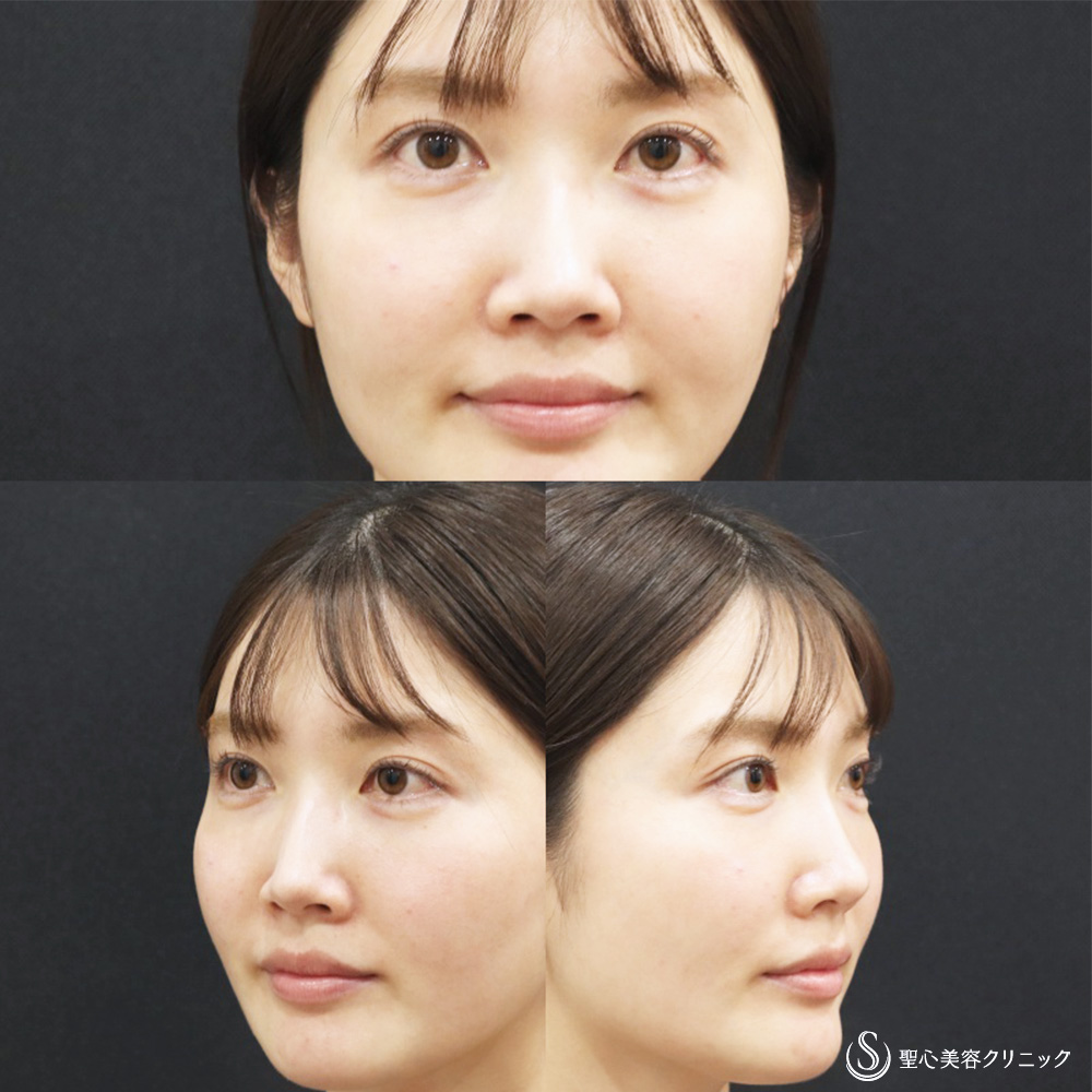【30代女性・優しく豊かな表情に】ヒアルロン酸注入（涙袋）（4日後） After 